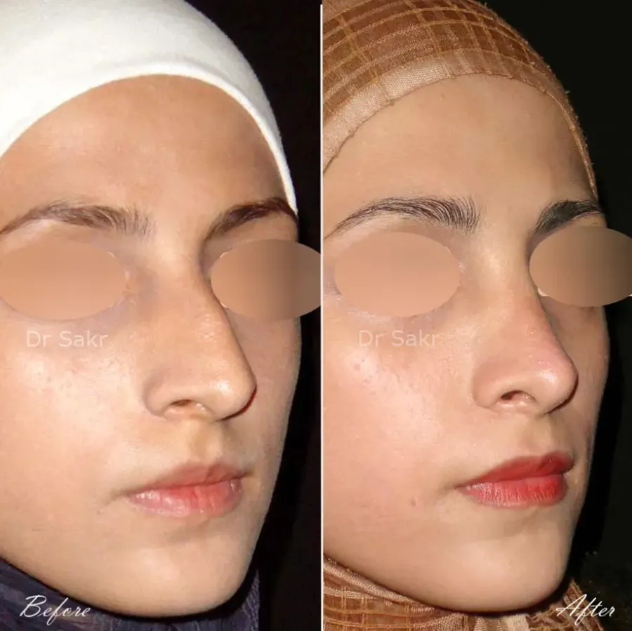 Original before and after nasal surgery photographs from Dr. Habouch's Humps gallery